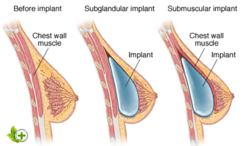 Breast Augmentation Surgery graph
