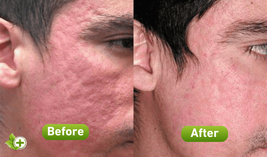 Before and after result of erbium laser resurfacing in a post about Laser Skin Resurfacing Treatment