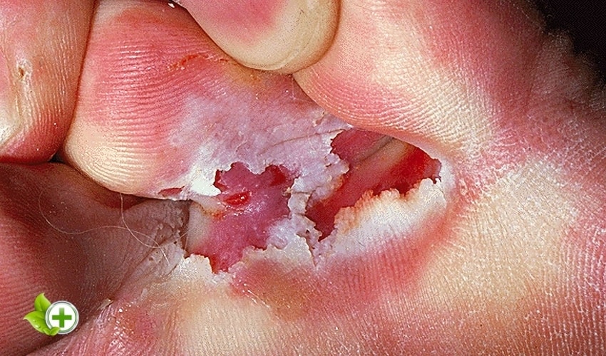 A foot with characteristic athlete’s foot  in a post about Foot Skin Peeling