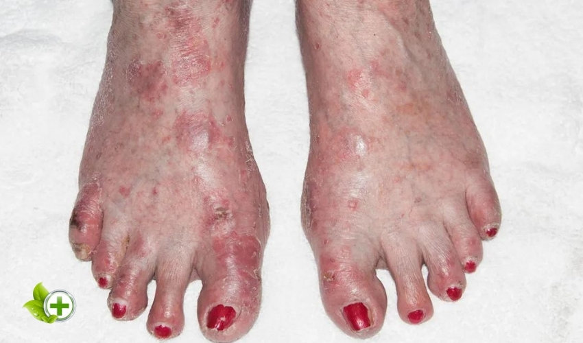 a foot with eczema in a post about Foot Skin Peeling