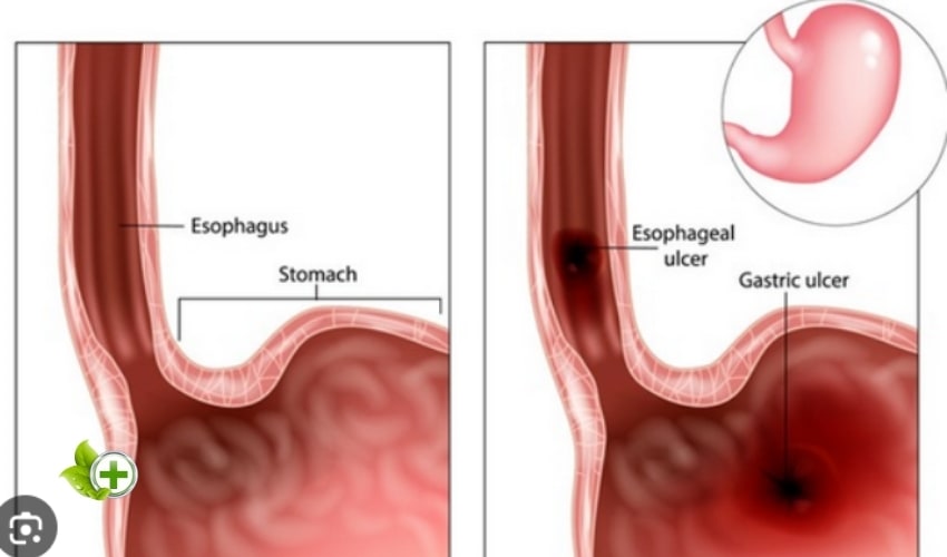 esophagus showing an ulcer. in a post about Peptic Ulcers