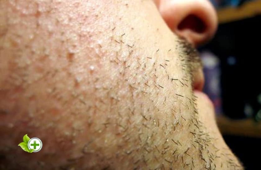 skin with razor bumps in a post about how to get rid of razor bumps overnight